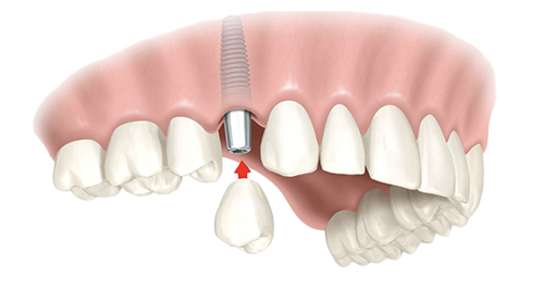 Single Dental Implants Clarence