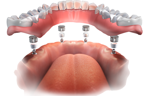 Implant Overdentures Clarence